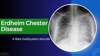 ERDHEIM CHESTER DISEASE  A Rare multisystem disorder [upl. by Lesoj]