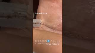 Process of Scar Healing scarhealing tummytuckrecovery tummytucksurgery plasticsurgeryresults [upl. by Aicarg]