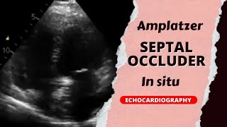 Amplatzer device in situ with right ventricle dilation cardiology echo echocardiography [upl. by Strage]