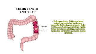 Familial adenomatous polyposis [upl. by Nolyarb349]