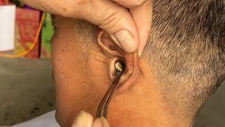 Removing ear blockage use manual tools [upl. by Sebastien]