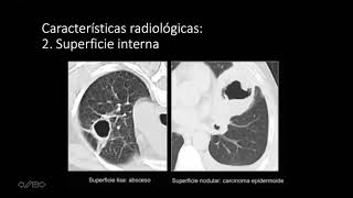 PATRON CAVITARIO PULMONAR mp4 [upl. by Nuawed]