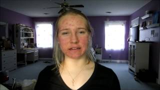 Accutane Journey 1 month on Accutane [upl. by Euqinehs292]