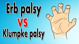 Erbs Palsy vs Klumpkes Palsy [upl. by Yenahteb]