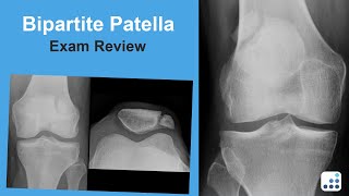 Bipartite Patella Exam Review  C Lowry Barnes MD [upl. by Remle]