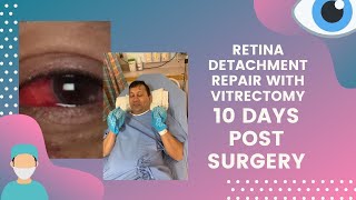 Retina Detachment Vitrectomy Surgery Recovery [upl. by Snow]