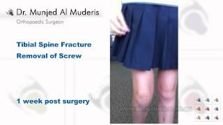 Tibial Spine Fracture Screw Removal  1 week post surgery [upl. by Sheilah]