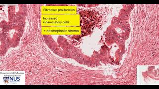 Colon carcinoma microscopy  Talking slide [upl. by Ecinehs]