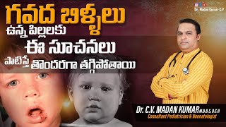 Mumps in Telugu గవద బిళ్ళలుMumps in children Dr Madan Kumar cv [upl. by Reagan]