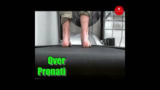 Discover the secrets of Over Pronation in our latest video Stay informed stay healthy [upl. by Furlong]