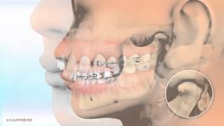 Carriere® Motion™ Appliance for Class II Patients  Braces and Invisalign Ortho  Madison GA [upl. by Hoffmann794]