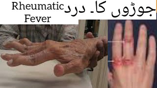 Rheumatic Fever Causes Symptoms Treatment Diagnose Medicine for Rheumatic Fever in HindiUrdu [upl. by Meirrak520]