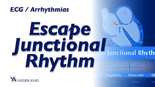 ECG 54  Escape Junctional Rhythm [upl. by Phelips]