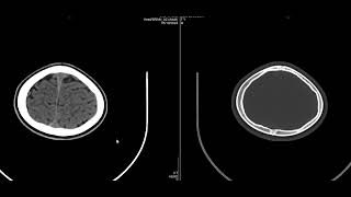 case 11b  CT of the case 11a [upl. by Sulienroc113]