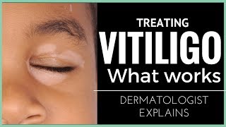 Vitiligo treatments what works [upl. by Annaoj]