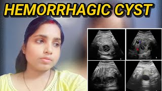 I am suffering from hemrroghic cyst on the ovary [upl. by Eilojne]