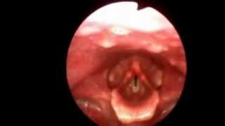 Flexible Video Stroboscopy Exam Kansas Voice Center [upl. by Etnahsa34]