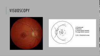 Visuoscopy Fixation Ophthalmoscopy [upl. by Nirrej]