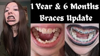 1 YEAR amp 6 MONTHS ADULT BRACES UPDATE🦷 [upl. by Atterahs]