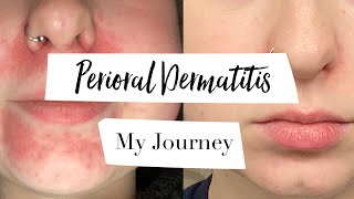 How I Treated My Perioral Dermatitis  MY JOURNEY [upl. by Selokcin]