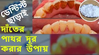 ডেন্টিস্ট ছাড়াই দাঁতের পাথর দূর করার উপায়  how to remove tartar at home  bangla health tips [upl. by Tomasz95]