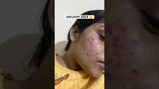 How I cleared my Acne  Acne journey  Get rid of acne  Adult Acne  Products that helped me [upl. by Doty266]