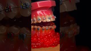 Braces ASMR The Chewy Crunchy Sounds of Jaw Braces [upl. by Kalikow]