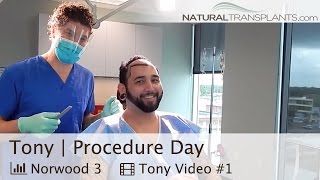 Hair Transplant Patient Travels 4750 Miles to Miami for Procedure at Natural Transplants Tony [upl. by Amati730]