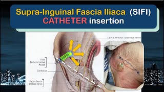 SupraInguinal Fascia Iliaca SIFI Catheter Insertion  the SUPRAINGUINAL approach [upl. by Atirb]