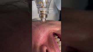 NCTF Boost 135HA with Potenza RF Microneedling  8 West Clinic  Vancouver BC [upl. by Ehlke54]