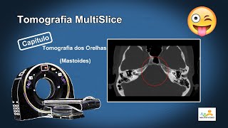 Tomografia dos Orelhas Mastoides Dicas e Truques [upl. by Smaoht306]