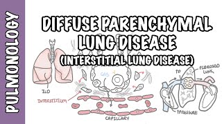 Interstitial Lung Disease ILD  Classification pathophysiology signs and symptoms [upl. by Gruber14]