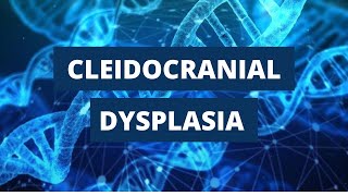 Cleidocranial Dysplasia Introduction Etiology Clinical Features and Treatment [upl. by Merrel560]