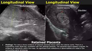 Postpartum Uterus Ultrasound Reporting  RPOCRetained Placenta Scan Reports  Pelvic USG [upl. by Eusadnilem352]