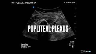 Popliteal plexus  Motorsparing block for TKA  alternative to IPACK Ultrasound regional anesthesia [upl. by Akemat]