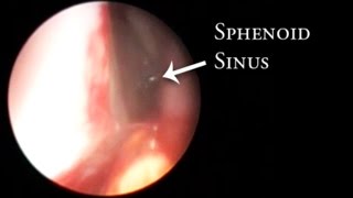 Inoffice balloon dilation of the sphenoid sinus [upl. by Dahsar]