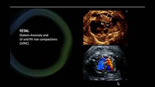 Fetal Ebstein noncompaction [upl. by Lebasiairam]