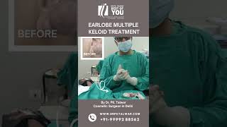 Bilateral Ear Keloid Surgery  Keloid Removal Surgery and Its Results  Dr PK Talwar [upl. by Popper63]