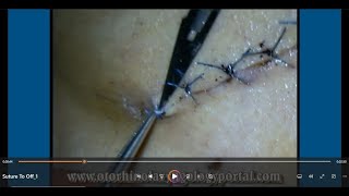 Suture To Off Removal of Sutures [upl. by Nylannej]