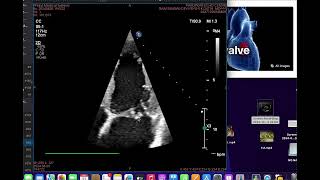 Flail anterior mitral leaflet [upl. by Lion]