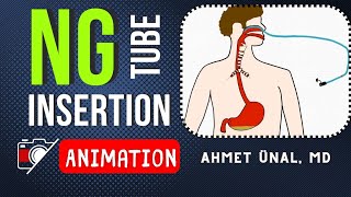 NG Nasogastric TUBE INSERTION  ANIMATION [upl. by De Witt]