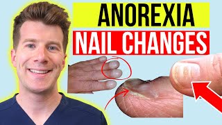 6 finger nail changes seen in ANOREXIA  Doctor explains [upl. by Sadiras]