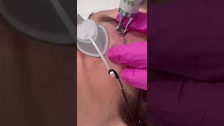 Tattoo eyebrow removal  Dr Medispa [upl. by Erickson]