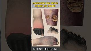 Types of Gangrene  Diabetic Foot  Gangrene  Dr Gaurav Gangwani [upl. by Aicitel]