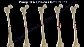 Fractures Of The Femur Shaft Winquist amp Hansen  Everything You Need To Know  Dr Nabil Ebraheim [upl. by Arlin427]