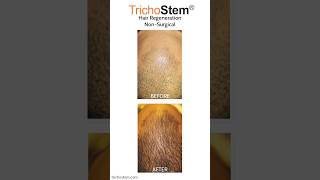 Why TrichoStem Hair Regeneration Patients can Stop Using Minoxidil minoxidil [upl. by Ramed]