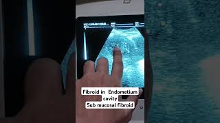 Endometrium fibroid sub mucosal shortyoutubevideo loveultrasound pregnant pregnant [upl. by Notlimah]