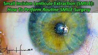 How To Perform SMILE Laser Eye Surgery [upl. by Ahseret162]