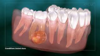 Dental Abcess  Why Root Canal Treatment Is Needed [upl. by Benildas315]