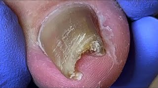 Amazing Curly and growing onychomycosis professional pedicure【Doctor Liu Pedicure】 [upl. by Westland307]